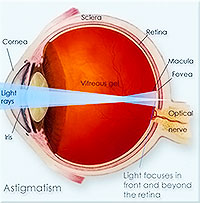 Astigmatism