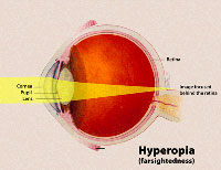 Hyperopia