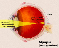 Myopia