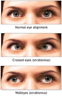 Strabismus